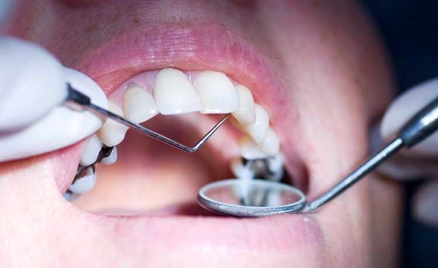 What-Are-the-Common-Causes-of-Front-Tooth-Cavity