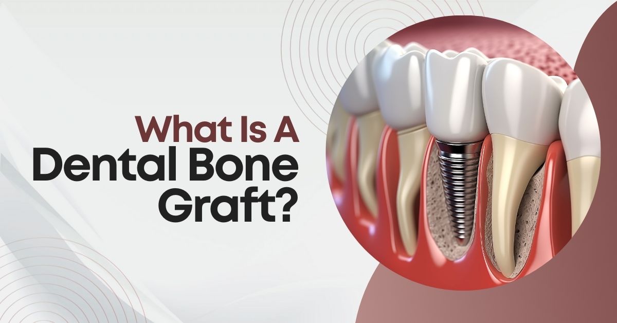 Illustration of a dental implant with bone graft, showing restored jawbone structure beneath teeth, alongside text that reads 'What Is A Dental Bone Graft?